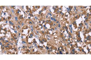Immunohistochemistry of paraffin-embedded Human thyroid cancer using SERPINA1 Polyclonal Antibody at dilution of 1:30 (SERPINA1 抗体)