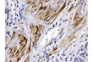 Cofilin 2 was detected in paraffin-embedded sections of human prostatic cancer tissues using rabbit anti- Cofilin 2 Antigen Affinity purified polyclonal antibody (Catalog # ) at 1 µg/mL. (Cofilin 2 抗体  (C-Term))