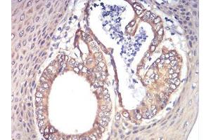 Immunohistochemical analysis of paraffin-embedded esophageal cancer tissues using RAD21 mouse mAb with DAB staining. (RAD21 抗体  (AA 287-403))