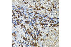 Immunohistochemistry of paraffin-embedded Human liver cancer using HLA-DPB1 antibody (ABIN7268370) at dilution of 1:100 (40x lens). (HLA-DPB1 抗体)