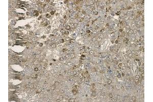 ABIN6255476 and ABIN6267169 at 1/100 staining human melanoma by IHC-P. (REPS1 抗体  (pSer709))