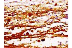 Immunohistochemistry of paraffin-embedded human melanoma using ABIN7160388 at dilution of 1:100 (MAZ 抗体  (AA 30-80))