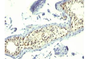 Formalin-fixed, paraffin-embedded human Testicular Carcinoma stained with Thymidylate Synthase Mouse Monoclonal Antibody (TS106). (TYMS 抗体)