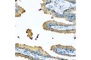 Immunohistochemical analysis of LRP5 staining in human prostate cancer formalin fixed paraffin embedded tissue section.
