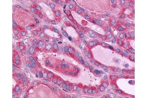 Anti-CD97 antibody IHC of human Thyroid, Follicular Carcinoma. (CD97 抗体  (Cytoplasmic Domain))
