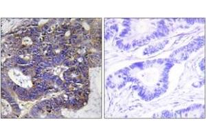 Immunohistochemistry analysis of paraffin-embedded human colon carcinoma tissue, using Collagen IV alpha2 Antibody. (COL4a2 抗体  (AA 151-200))