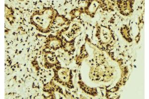 ABIN6274287 at 1/100 staining Human breast cancer tissue by IHC-P. (CEBPG 抗体  (Internal Region))