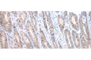 Immunohistochemistry of paraffin-embedded Human gastric cancer tissue using ATG16L1 Polyclonal Antibody at dilution of 1:40(x200)
