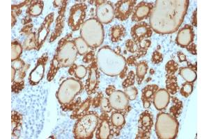 Formalin-fixed, paraffin-embedded human thyroid carcinoma stained with TPO Recombinant Rabbit Monoclonal Antibody (TPO/3813R). (Recombinant TPO (AA 685-804) 抗体)