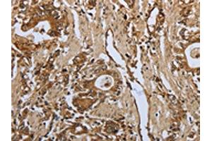The image on the left is immunohistochemistry of paraffin-embedded Human gastic cancer tissue using ABIN7191969(PPARA Antibody) at dilution 1/30, on the right is treated with synthetic peptide. (PPARA 抗体)