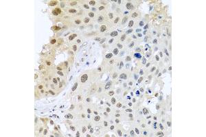 Immunohistochemistry of paraffin-embedded human lung cancer using DNAL1 antibody (ABIN5974658) at dilution of 1/100 (40x lens). (DNAL1 抗体)