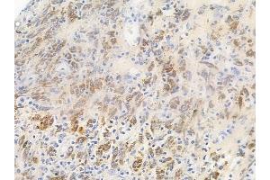 ABIN6256746 and ABIN6267646 at 1/100 staining human melanoma by IHC-P. (Cortactin 抗体  (pTyr466))