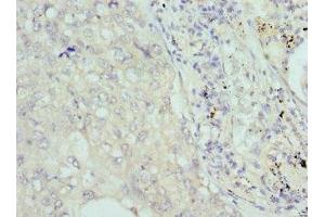 Immunohistochemistry of paraffin-embedded human lung cancer using ABIN7148039 at dilution of 1:100 (COCH 抗体  (AA 20-260))
