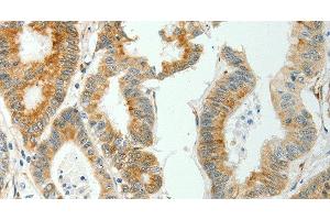 Immunohistochemistry of paraffin-embedded Human colon cancer tissue using SELENOM Polyclonal Antibody at dilution 1:50 (SELM 抗体)