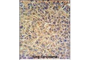 EXOC3L2 Antibody (N-term) (ABIN651216 and ABIN2840135) IHC analysis in formalin fixed and paraffin embedded human lung carcinoma followed by peroxidase conjugation of the secondary antibody and DAB staining. (EXOC3L2 抗体  (N-Term))