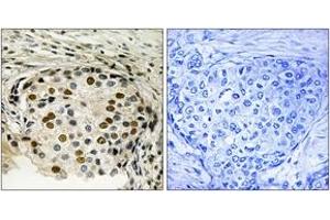 Immunohistochemistry analysis of paraffin-embedded human breast carcinoma, using OSR1 (Phospho-Thr185) Antibody. (OSR1 抗体  (pThr185))