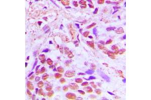 Immunohistochemical analysis of SRF staining in human breast cancer formalin fixed paraffin embedded tissue section.