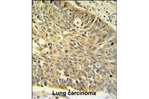 Immunohistochemistry (Paraffin-embedded Sections) (IHC (p)) image for anti-Methylenetetrahydrofolate Dehydrogenase (NADP+ Dependent) 1, Methenyltetrahydrofolate Cyclohydrolase, Formyltetrahydrofolate Synthetase (MTHFD1) (AA 535-562) antibody (ABIN389285)