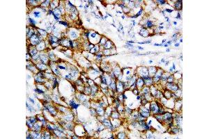 Anti-beta Catenin antibody, IHC(P): Human Mammary Cancer Tissue (CTNNB1 抗体  (N-Term))