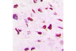 Immunohistochemical analysis of SKP2 staining in human lung cancer formalin fixed paraffin embedded tissue section. (SKP2 抗体  (C-Term))