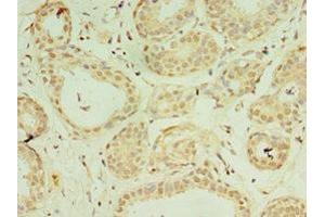 Immunohistochemistry of paraffin-embedded human breast cancer using ABIN7156912 at dilution of 1:100 (IL-37 抗体  (AA 1-218))