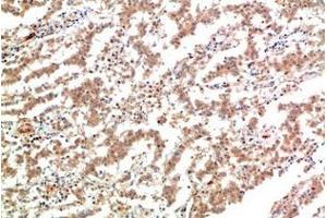 Immunohistochemistry of paraffin-embedded Human lung carcinoma tissue using JAK2 Monoclonal Antibody at dilution of 1:200. (JAK2 抗体)
