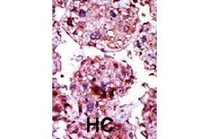 Formalin-fixed and paraffin-embedded human hepatocellular carcinoma tissue reacted with HK1 polyclonal antibody  , which was peroxidase-conjugated to the secondary antibody, followed by AEC staining. (Hexokinase 1 抗体  (N-Term))