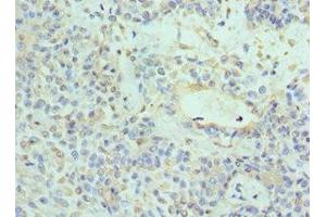 Immunohistochemistry of paraffin-embedded human breast cancer using ABIN7161741 at dilution of 1:100 (NTRK3 抗体  (AA 40-300))