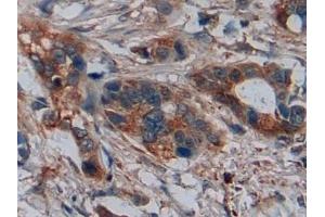 Detection of DISC1 in Human Pancreatic cancer Tissue using Polyclonal Antibody to Disrupted In Schizophrenia 1 (DISC1)