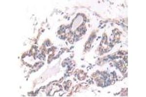 IHC-P analysis of Human Breast Cancer Tissue, with DAB staining. (IFNA5 抗体  (AA 22-189))