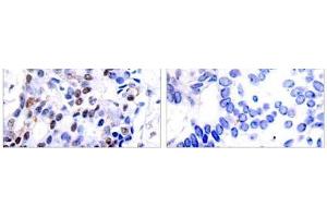 Immunohistochemical analysis of paraffin-embedded human breast carcinoma tissue using c-Jun (Ab-91) antibody (E021021). (C-JUN 抗体)