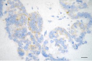 Immunohistochemistry was performed on paraffin-embedded human ovarian carcinoma using MSI2 antibody (ABIN7799495), 1:200).