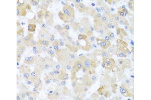 Immunohistochemistry of paraffin-embedded Human liver damage using CETN1 Polyclonal Antibody at dilution of 1:100 (40x lens). (Centrin 1 抗体)