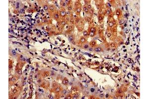 Immunohistochemistry of paraffin-embedded human liver cancer using ABIN7167943 at dilution of 1:100 (ARHGAP25 抗体  (AA 17-280))