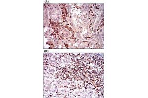 Immunohistochemical staining of human endometrial cancer tissues (A) and bladder cancer tissues (B) with CTNNBL1 monoclonal antibody, clone 1E4F5  at 1:200-1:1000 dilution. (CD68 抗体  (AA 42-155))