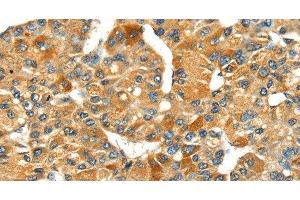 Immunohistochemistry of paraffin-embedded Human liver cancer using SPARC Polyclonal Antibody at dilution of 1:35 (SPARC 抗体)