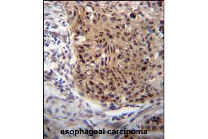 EXTL3 Antibody (N-term) (ABIN656662 and ABIN2845903) immunohistochemistry analysis in formalin fixed and paraffin embedded human esophageal carcinoma followed by peroxidase conjugation of the secondary antibody and DAB staining. (EXTL3 抗体  (N-Term))
