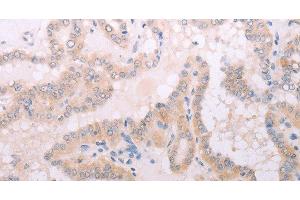 Immunohistochemistry of paraffin-embedded Human thyroid cancer tissue using TPO Polyclonal Antibody at dilution 1:50 (TPO 抗体)