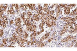 ABIN6278496 at 1/100 staining Human liver cancer tissue by IHC-P. (GRIN2C 抗体  (Internal Region))