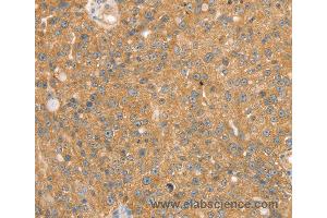 Immunohistochemistry of Human breast cancer using SNX2 Polyclonal Antibody at dilution of 1:40