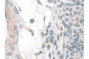 Detection of COQ6 in Human Skin cancer Tissue using Polyclonal Antibody to Coenzyme Q6 Homolog, Monooxygenase (COQ6) (COQ6 抗体  (AA 1-468))