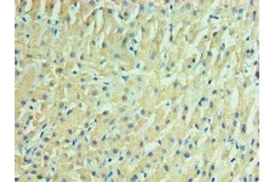 Immunohistochemistry of paraffin-embedded human liver cancer using ABIN7157125 at dilution of 1:100 (IDH2 抗体  (AA 193-452))