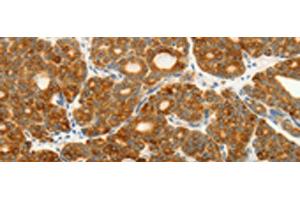 Immunohistochemistry of paraffin-embedded Human thyroid cancer tissue using VEGFB Polyclonal Antibody at dilution of 1:25(x200)