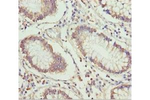 Immunohistochemistry of paraffin-embedded human colon cancer using ABIN7151499 at dilution of 1:100 (ETFA 抗体  (AA 1-333))