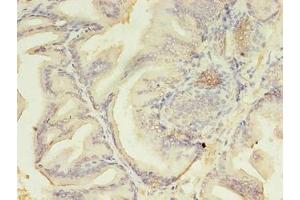 Immunohistochemistry of paraffin-embedded human prostate cancer using ABIN7176718 at dilution of 1:100 (AZGP1 抗体  (AA 61-210))