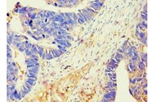 Immunohistochemistry of paraffin-embedded human ovarian cancer using ABIN7145213 at dilution of 1:100 (BAG2 抗体  (AA 1-211))