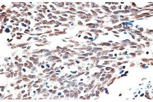 Immunohistochemistry of paraffin-embedded Human lung cancer using AQR Polyclonal Antibody at dilution of 1:100 (40x lens). (AQR 抗体)