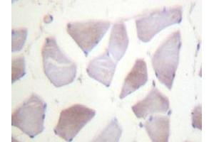 Immunohistochemistry analyzes of PP1α (G315) antibody in paraffin-embedded human breast carcinoma tissue. (CRYAB 抗体)