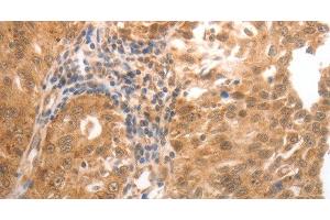 Immunohistochemistry of paraffin-embedded Human ovarian cancer tissue using MMP27 Polyclonal Antibody at dilution 1:50 (MMP27 抗体)