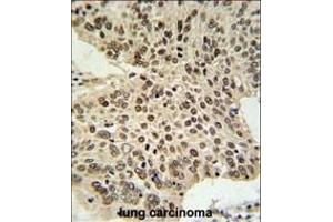 HIST1H2AL Antibody (C-term) (ABIN651090 and ABIN2840066) IHC analysis in formalin fixed and paraffin embedded human lung carcinoma followed by peroxidase conjugation of the secondary antibody and DAB staining. (HIST1H2AL 抗体  (C-Term))